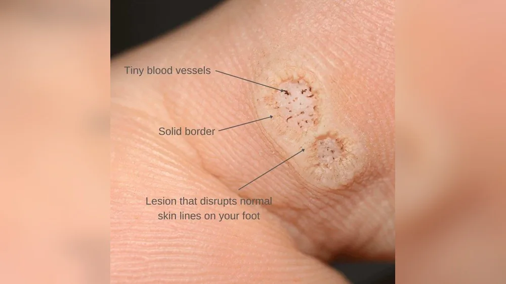 How Can You Get Planters Warts